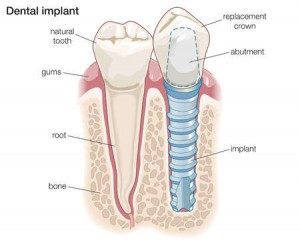 implants